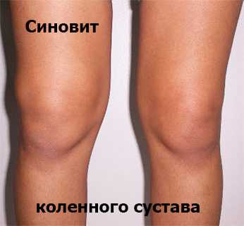 Использовать давящие повязки врачи рекомендуют не более дней