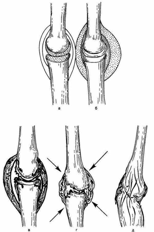 Синовит коленного сустава