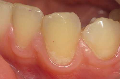 Однако если обнажился дентин и появились черные прожилки, одно фторирование в таком случае не поможет