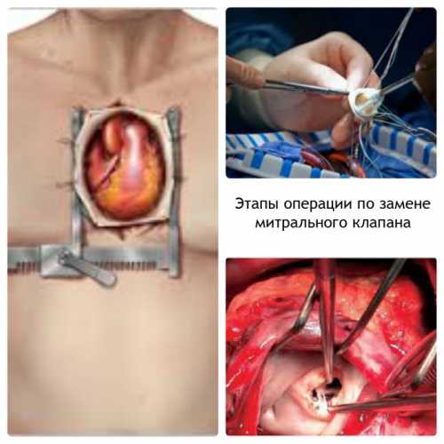 Операция на сердце через мини