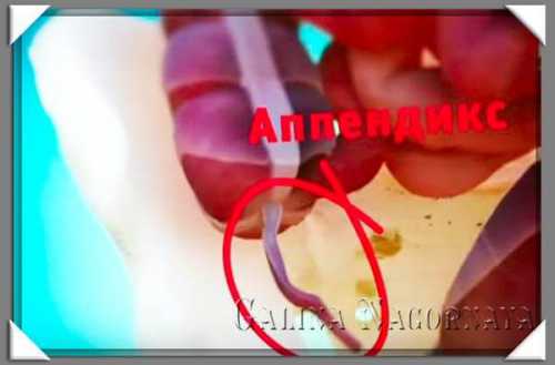 Воспаление аппендикса: симптомы, причины, это