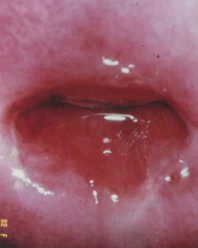 Гнойный цервицит особенно часто возникает на фоне гонореи