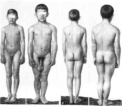 Мужские половые стероиды усиливают рост внутренних и наружных половых органов влияют на развитие придаточных желез формируют половые признаки вторичные, третичные усиливают линейный рост телаповышают процент мышечной тканивлияют на распределение подкожно жировой клетчатки