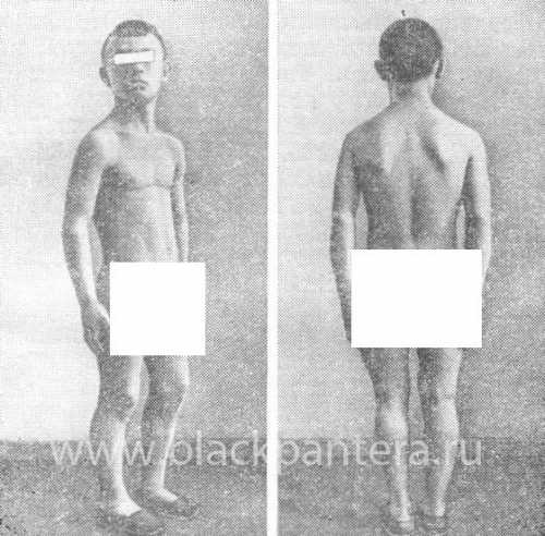 Во внутриутробном периоде происходит опускание яичек в мошонку