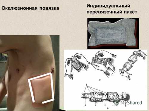 Циркулярная повязка