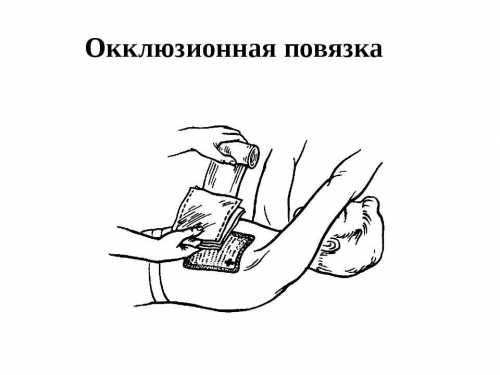 Спиральная повязка