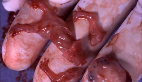 Выделения при беременности на ранних сроках