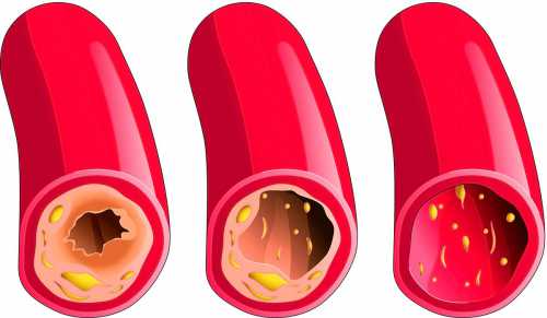 Воспаление стенок сосудов: симптомы, причины, это