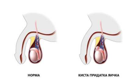 Патологические изменения репродуктивной системы, которые влекут за собой кисту может развиваться на фоне иных заболеваний
