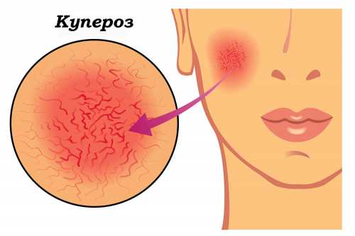 Среди процедур в салонах красоты, направленных на удаление купероза на лице, выделяют такие как