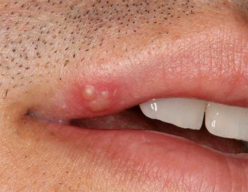 Не менее популярным средством является цинкоихтиловая мазь