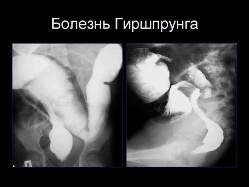 Осложнения и последствия