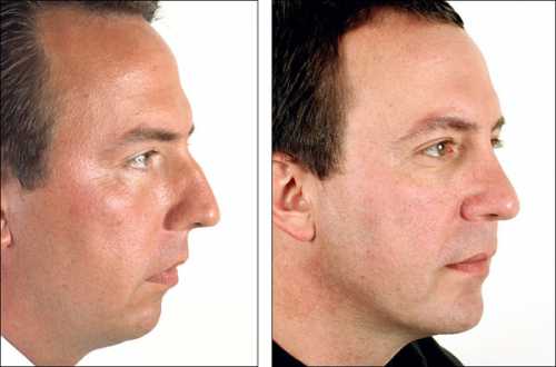 Все, что необходимо знать о наркозе во время эстетических операций