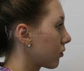 Пластика подбородка