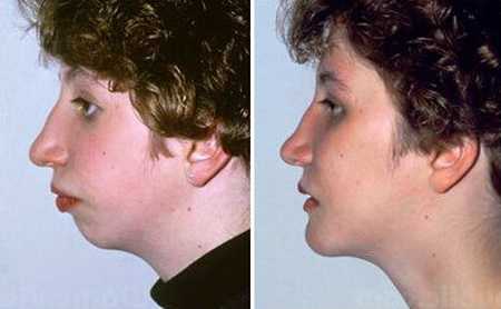 Сахарный диабет