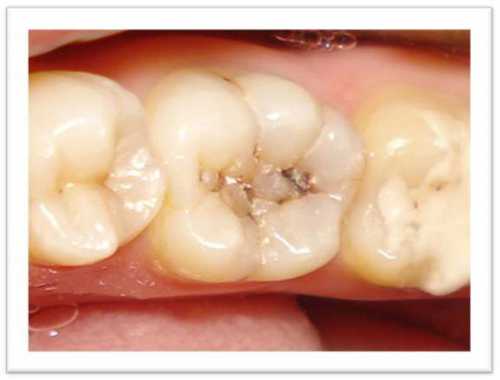Цель такой чистки убрать между зубов застрявшие кусочки пищи