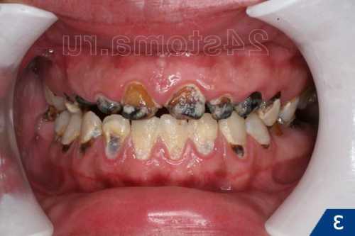 Как предотвратить кариес