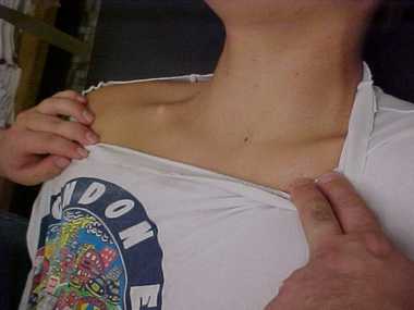 Остеосинтез ключицы