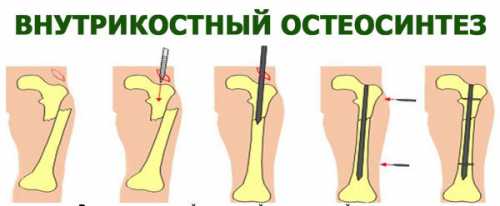 Остеосинтез бедра