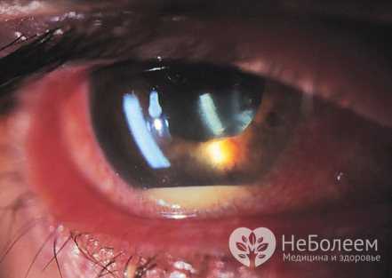 У пациентов с иридоцик литом появляется слезотечение, светобоязнь, перед глазами появление тумана, незначительное в районе строчек ухудшение остроты зрения