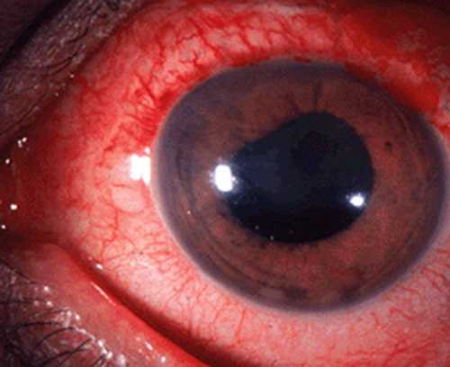 Вероятно, проявление перикорнеальной инъекции сосудов глазного яблока, выраженного умеренного роговичного синдрома