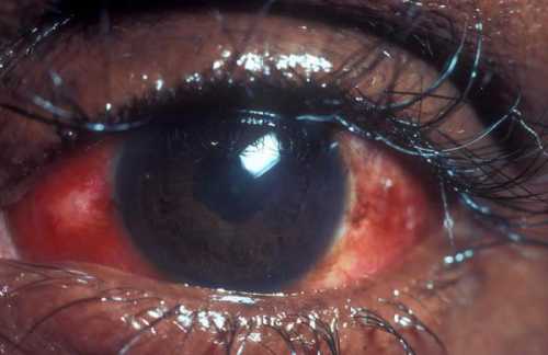 Иридоциклит острый, хронический