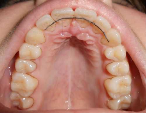 Воспаление нёба симптомы, причины, это