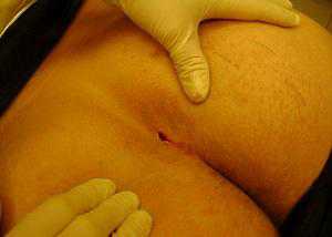 Чем раньше проведено хирургическое вмешательство, тем меньше вероятность формирования осложнений, легче техническая часть операции, благоприятнее восстановительный послеоперационный период