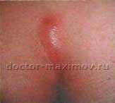 Методики, направленные на иссечение кисты копчика