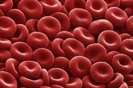 Эта процедура удаляет лишние эритроциты, а это один из способов уменьшить количество гемоглобина в крови