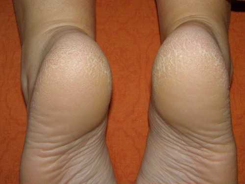 Для приготовления лечебного раствора один литр теплой воды добавить пару столовых ложек крахмала, после растворения слейте в таз