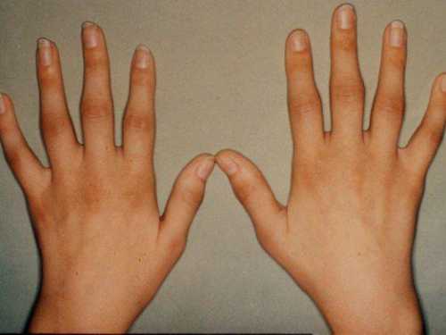 Отекают руки кисти, пальцы